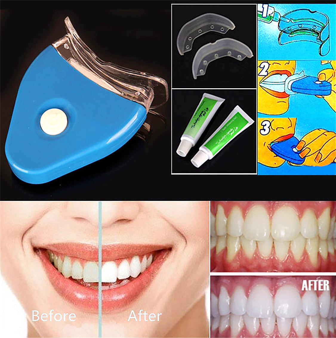 LED Teeth Whitening Kit